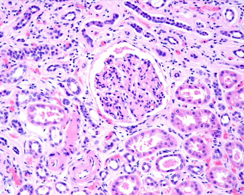 nephropathie chronique grave